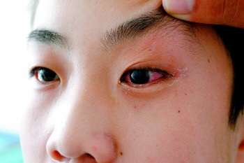 孩子的左眼被炸伤， 视力受损。 记者 王鑫 摄