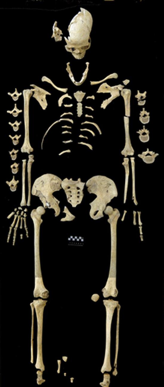 科学家在德国斯图加特米尔豪森地区的一处新石器时代的墓地中发现一具7000年前的女性残骸，或为迄今已知的最古老的白血病患者遗骸。（网页截图）