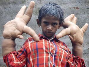 印度巨指症男孩接受手术