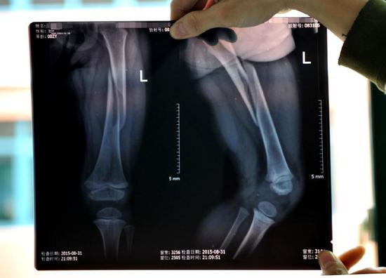 X光片显示佳佳左腿骨折。
