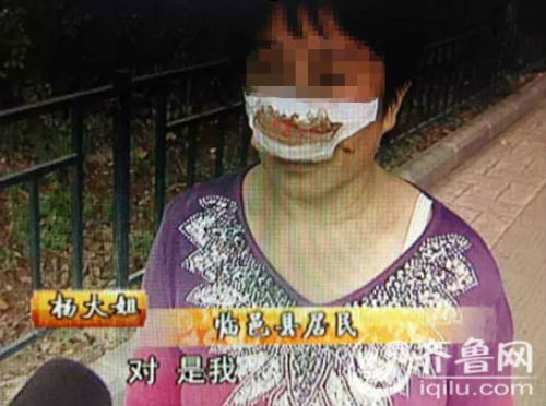 楊大姐自稱來自德州臨邑,鼻子是被丈夫一口咬掉的。(視頻截圖)