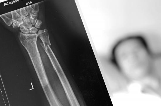 9月8日，杨宝华还躺在医院接受治疗，X光片显示，他的左手骨折。图/记者陈正