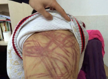 南京虐童案法医鉴定结果出炉:孩子被认定轻微伤