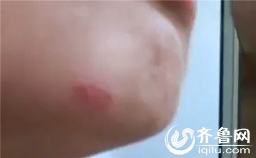 假期孩子回家,王女士发现,孩子身上满是伤痕。