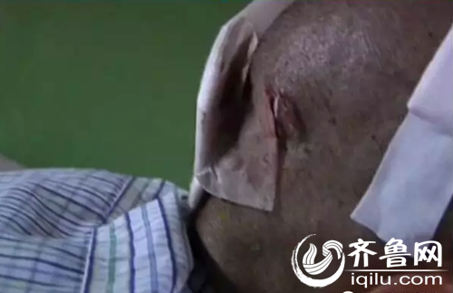 老人被亲生儿子打得颅骨受到重伤，脑内有淤血。（视频截图）