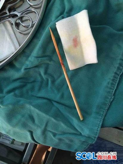 被插入到下颌骨的竹签