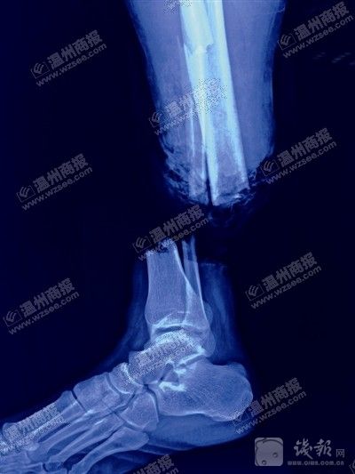 X光显示鲍成远右小腿完全被勒断。医院供图金鱼翻拍　