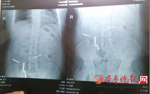 X光片顯示, “陳洋” 腹內有大量釘子狀金屬異物。