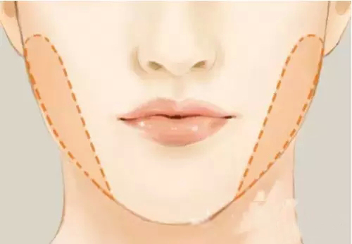 口?现在流行的是无痕整形!|angelababy|整形|无