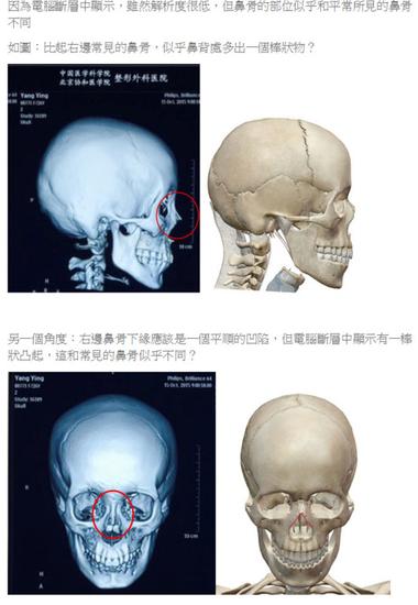 台整型医师质​​疑杨颖面部鉴定结果