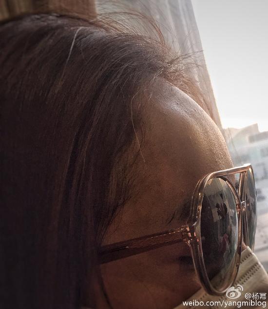 杨幂额头被撞出大包