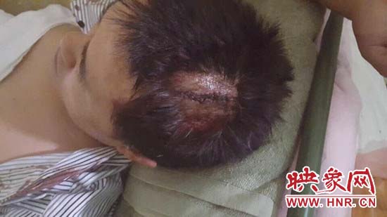 魏文龍頭部被鐵棍打傷，傷口長達6厘米。