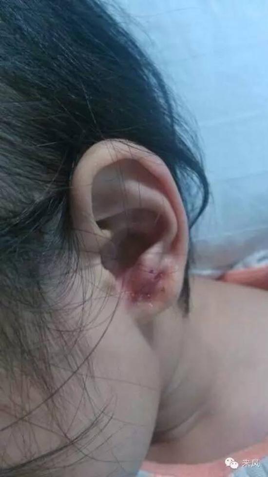 耳朵上的傷口。