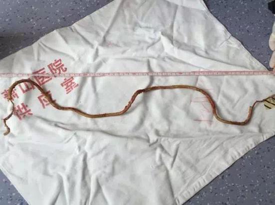 膀胱中取出的电线。
