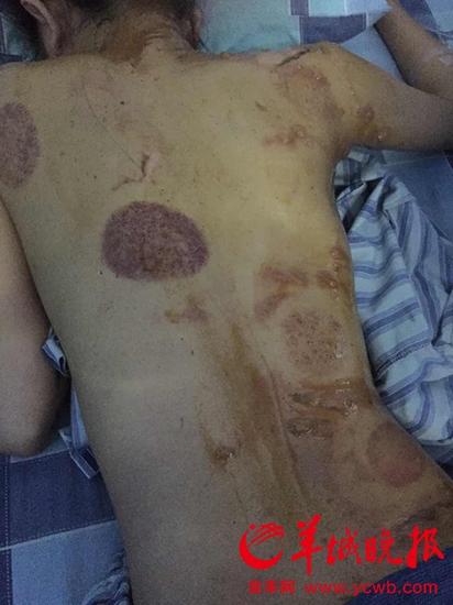 广州17岁少女光顾沐足城拔火罐被烧伤