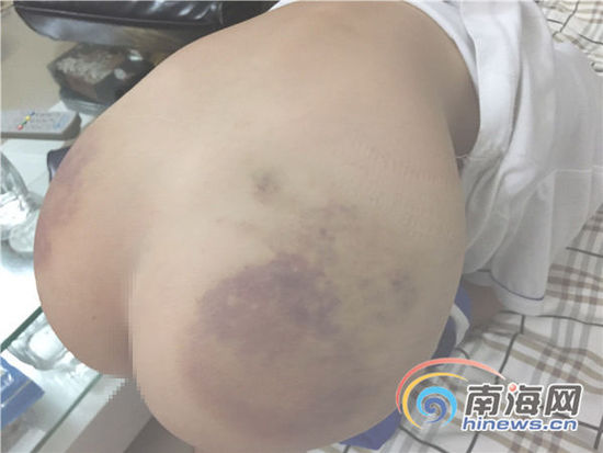男童身上的淤青