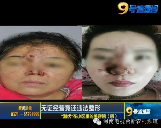 郑州女子美容院注射瘦脸针造成毁容 照片触目惊心