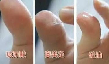 玻尿酸、奧美定、硅油的區別。(圖片來自網絡)