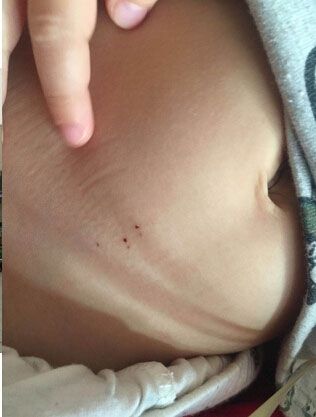 孩子身上的傷痕