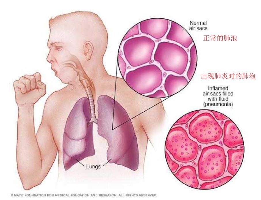肺气泡能自愈吗 新浪网