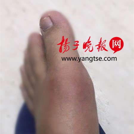 关节病,与嘌呤代谢紊乱和(或)尿酸排泄减少所致的高尿酸血症直接相关