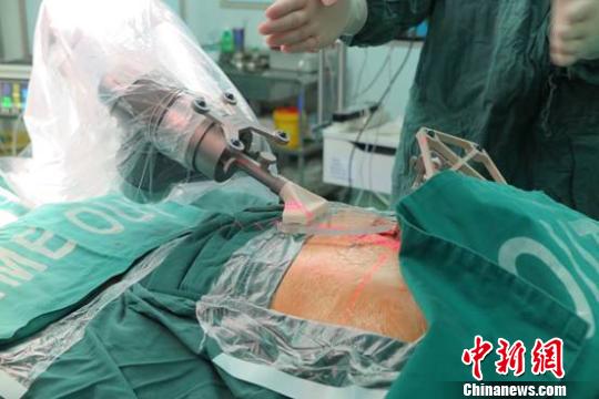 中国东北首例天玑机器人辅助脊柱手术在沈阳