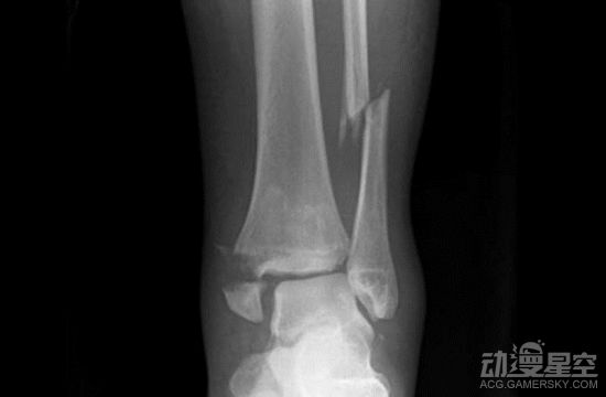 马来西亚男子使用《一拳超人》锻炼法受伤 魔鬼训练不要随便试