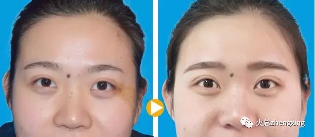 让你对整形知道的多一点 咖啡斑是什么