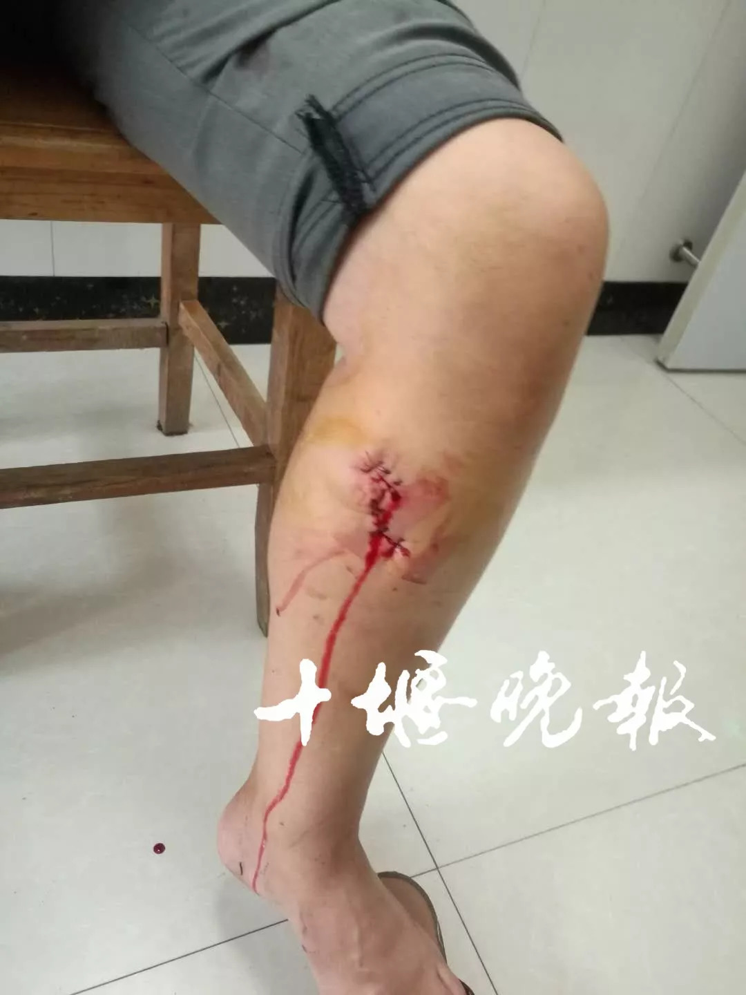 杨梅莲被野狗咬伤了右腿和左胳膊