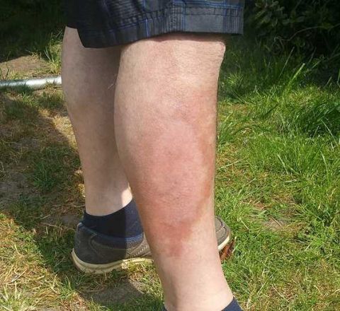 55岁男子在被蜘蛛咬伤后腿部严重感染 并渗出水泡