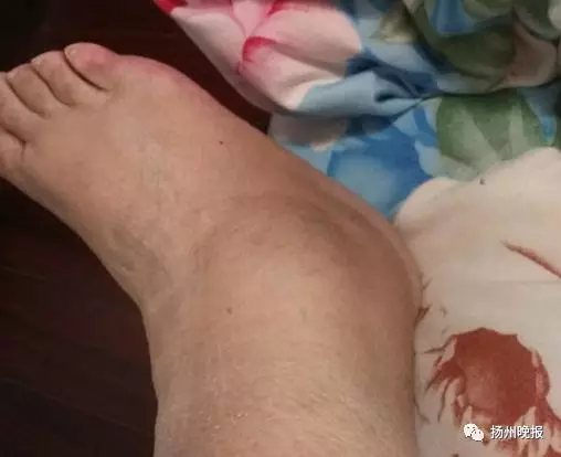 谢女士的右脚踝肿得像“馒头”