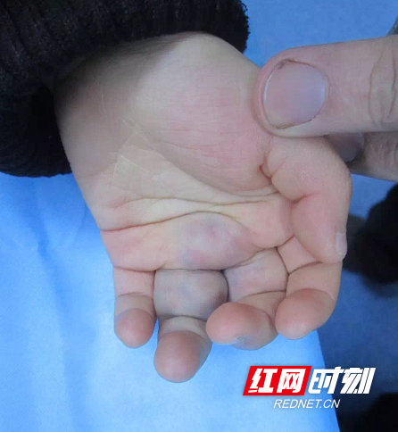 7岁孩童病情被耽搁 竟导致血管瘤畸变