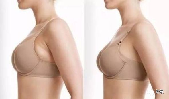 副乳穿什么样的内衣图_腋下副乳图片(2)