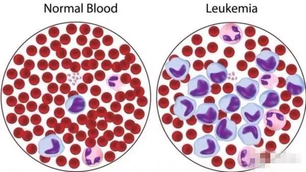 正常血细胞对比患者血细胞