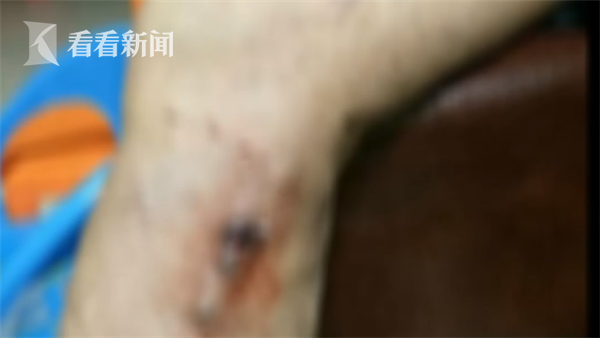 嗓子疼扎针放血是什么原理_嗓子疼中医扎针