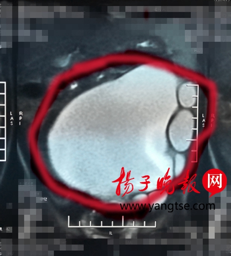 一岁宝宝肾积水 腹部胀如西瓜