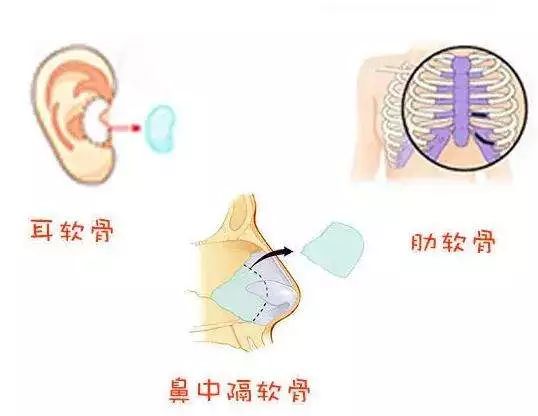 自体软骨