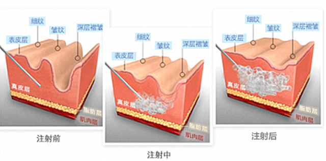 打玻尿酸