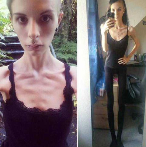 厌食症女孩瘦成皮包骨，每天晕倒好几次甚至不能自己洗澡