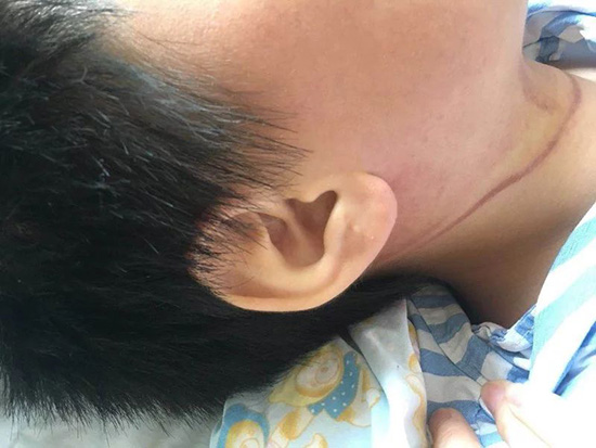 小鹏脖子上的勒痕