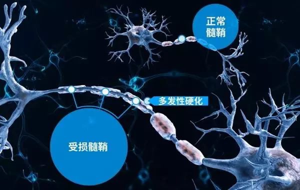 天才大提琴家的琴弦为何而断?让我们认识多发