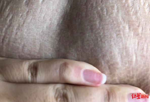 去祛妊娠纹产品排行榜_祛妊娠纹产品排行榜十强品牌推荐(组图)