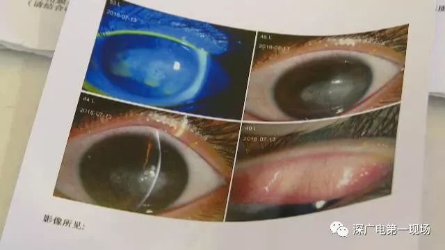 网购了隐形眼镜,女生在佩戴后差点瞎了!原因竟是……