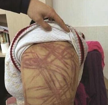 4月3日晚，微博网友“朝廷半日闲”展示小毛被虐待后身上留下的伤痕。
