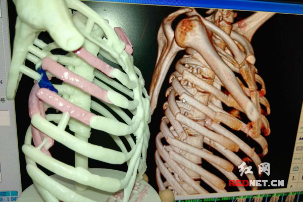 7根肋骨断成数截3D打印复制成功手术 成世界
