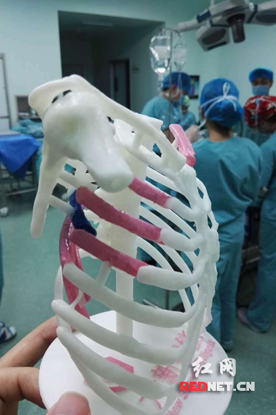 7根肋骨断成数截3d打印复制成功手术 成世界首例