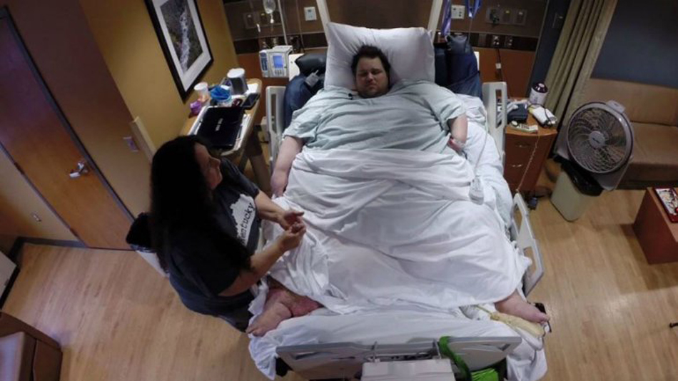 世界最胖男子减肥手术后患疝气 被迫切除80厘