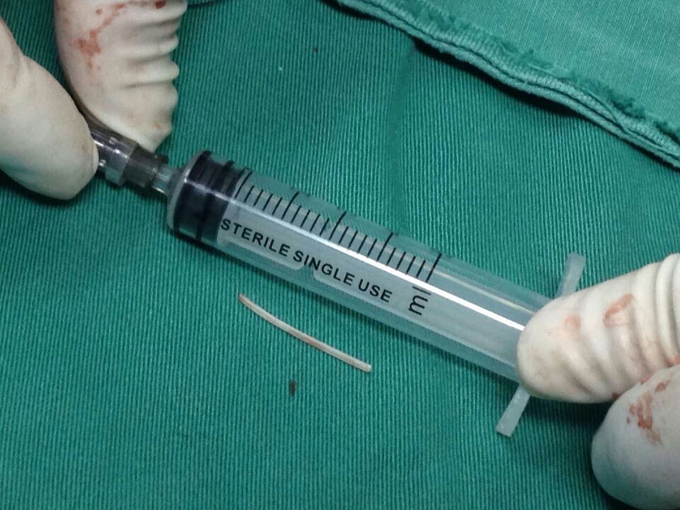 武汉女子鱼刺卡喉硬吞饭 食管被扎穿|鱼刺|食管