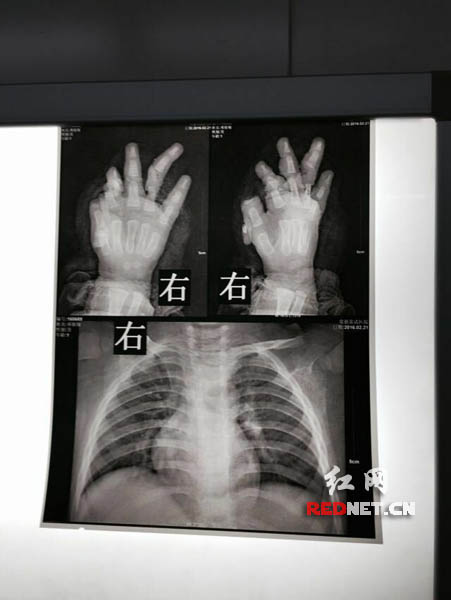 闹腾元宵节 常德2岁男童5根手指被机器绞断