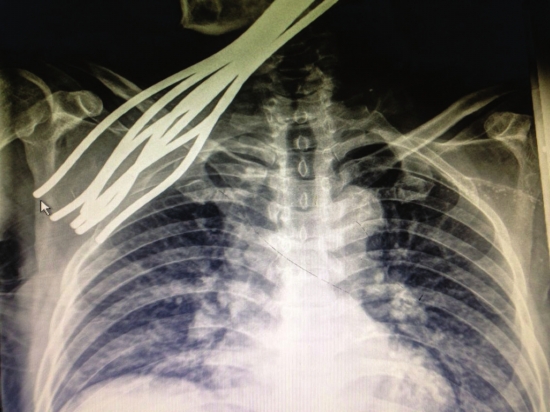 五旬工人作业时遭遇飞来横祸 七根钢筋插进身